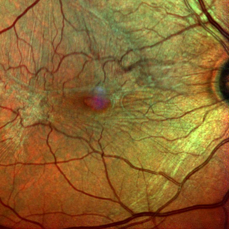 Behandlung Epiretinale Gliose